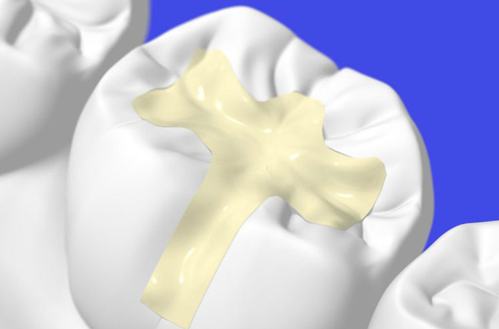 What are Cavities and Why Do I Need Tooth-Colored Fillings in Canton?