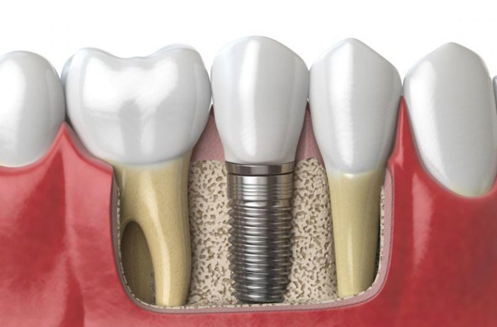 4 Easy Ways to Protect Your Dental Implant from Infection