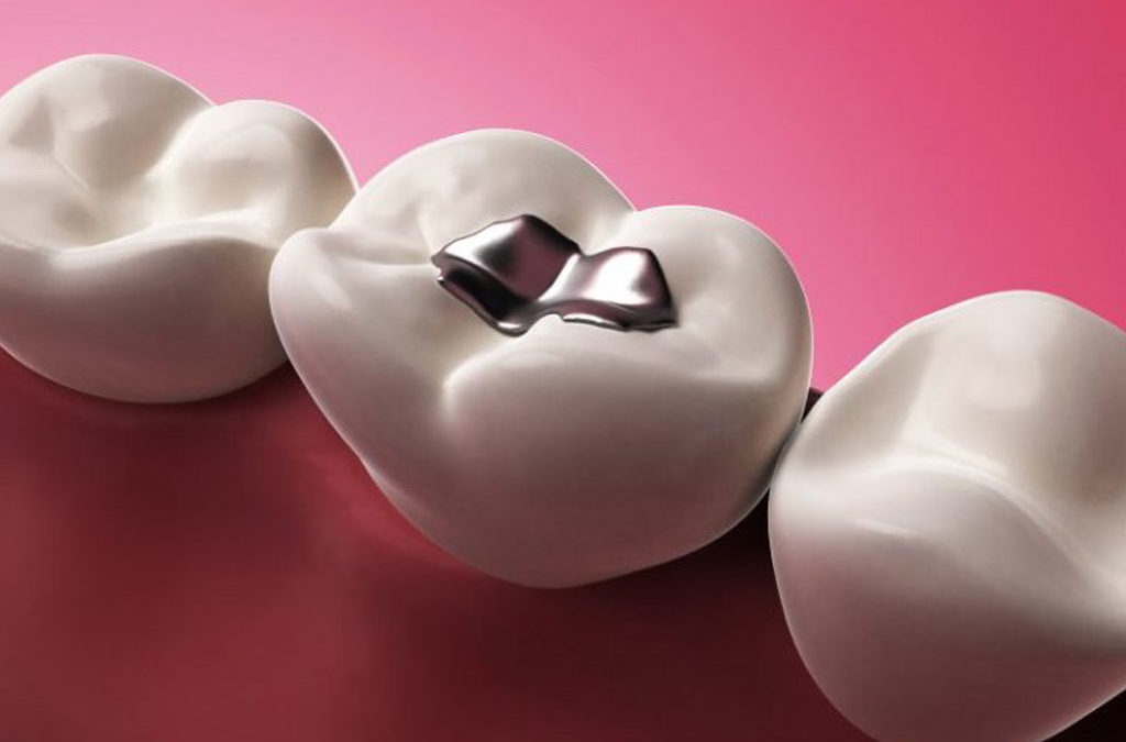 Trade Your Shiny Metal Fillings for a Safer, Unnoticeable Alternative