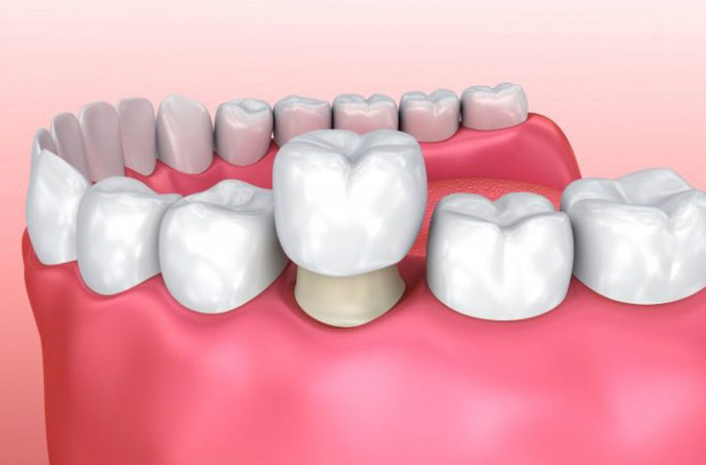 dentists office legacy dental group canton tx blog What to Do If You Break a Dental Crown in Canton